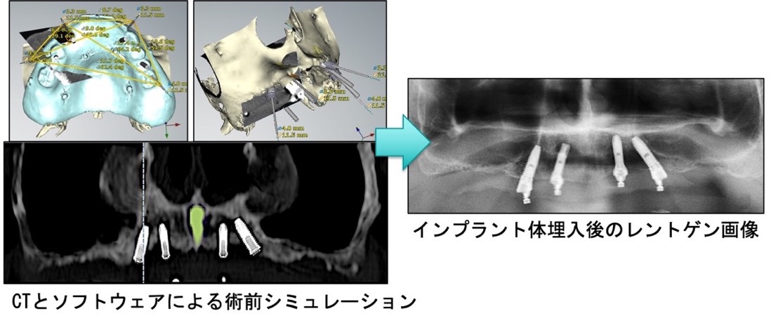 先端治療例０